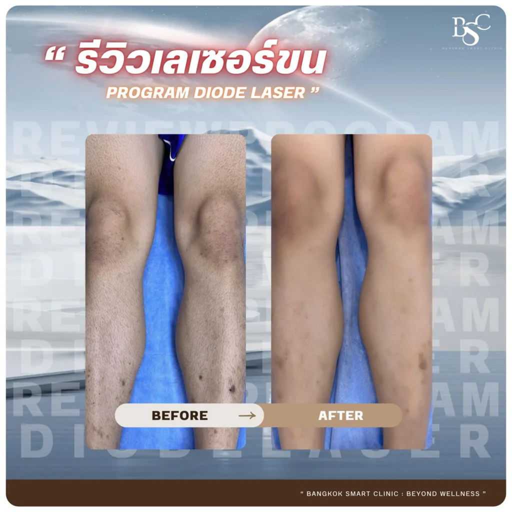 เลเซอร์กำจัดขน