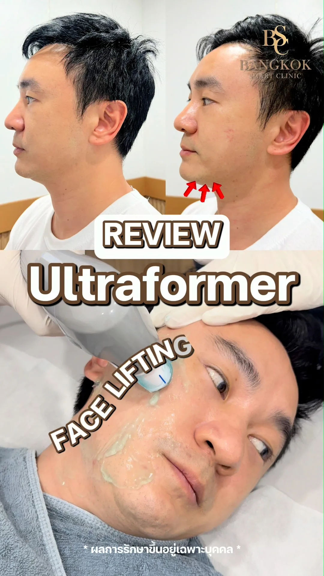 กระชับใบหน้า