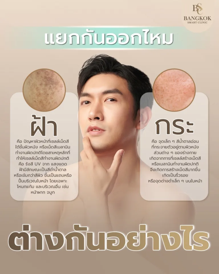 ฝ้า vs กระ