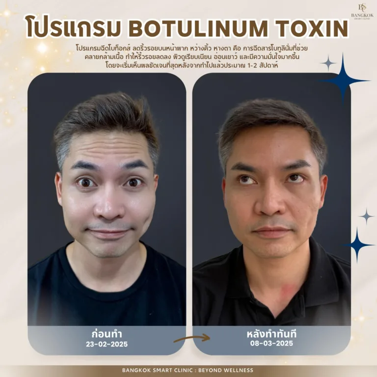 Botulinum Toxin