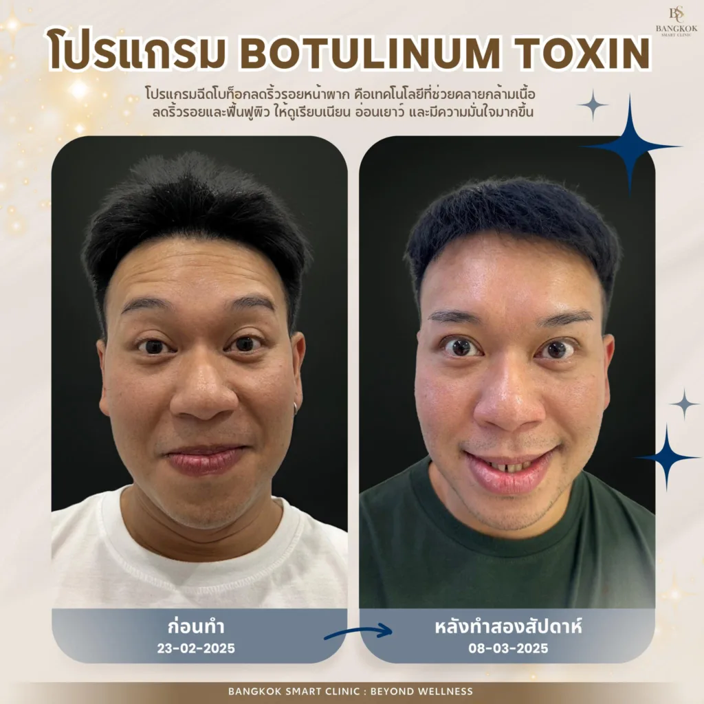 Botulinum Toxin
