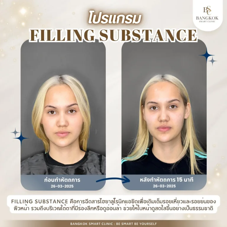 เติมเต็มผิวหน้า