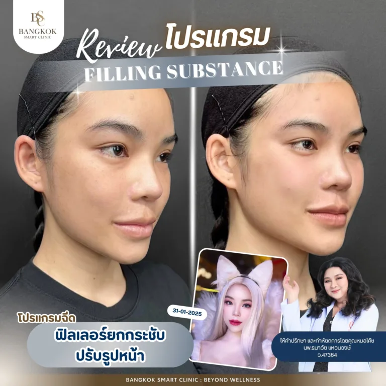 ฉีดฟิลเลอร์ยกกระชับ