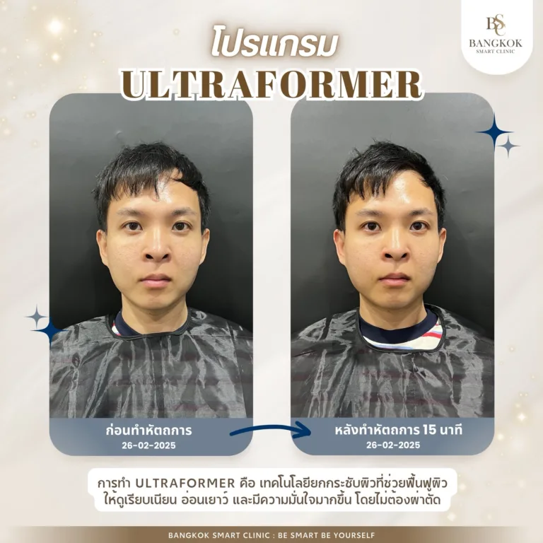 Ultraformer