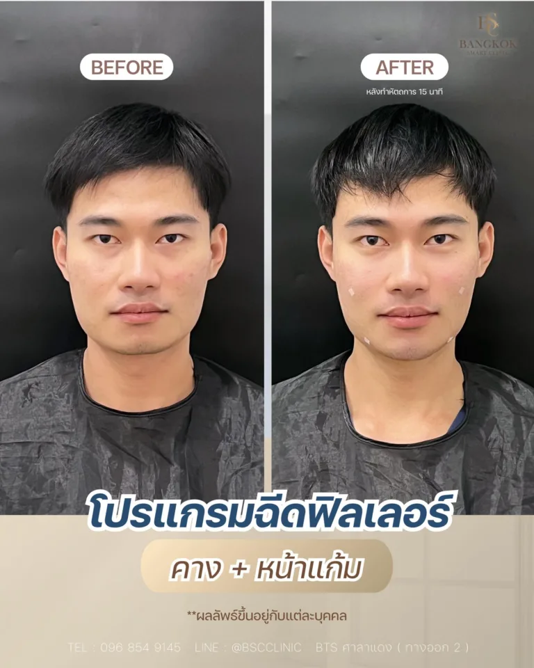 เติมคาง