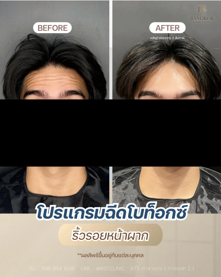 ลดรอยหน้าผาก