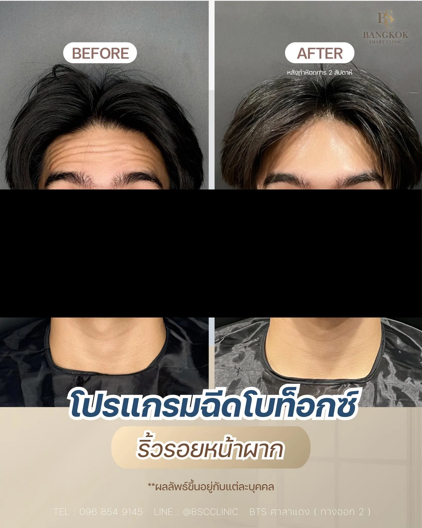 ลดรอยหน้าผาก